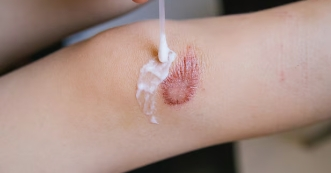 Wound Healing Wound Healing