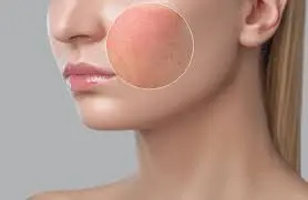 ease skin aggravation ease skin aggravation