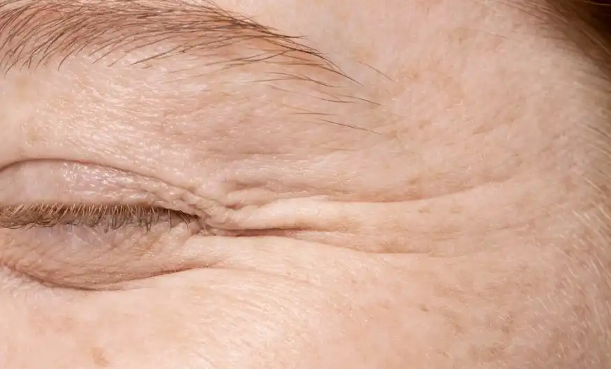 Skin Elasticity