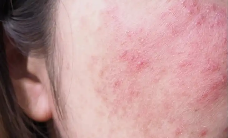 Calms Irritation and Redness